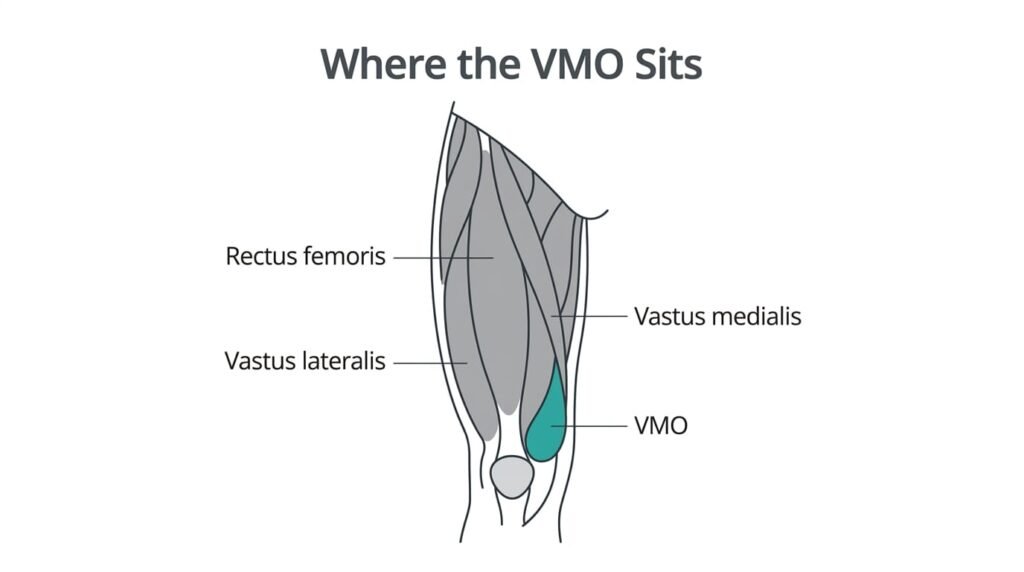 Diagram of the quadriceps on the front of the thigh with the VMO highlighted in teal above the inner knee